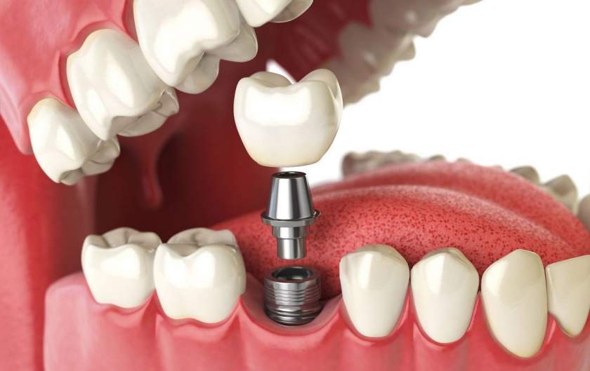 Ce este necesar sa stim despre implanturile dentare?